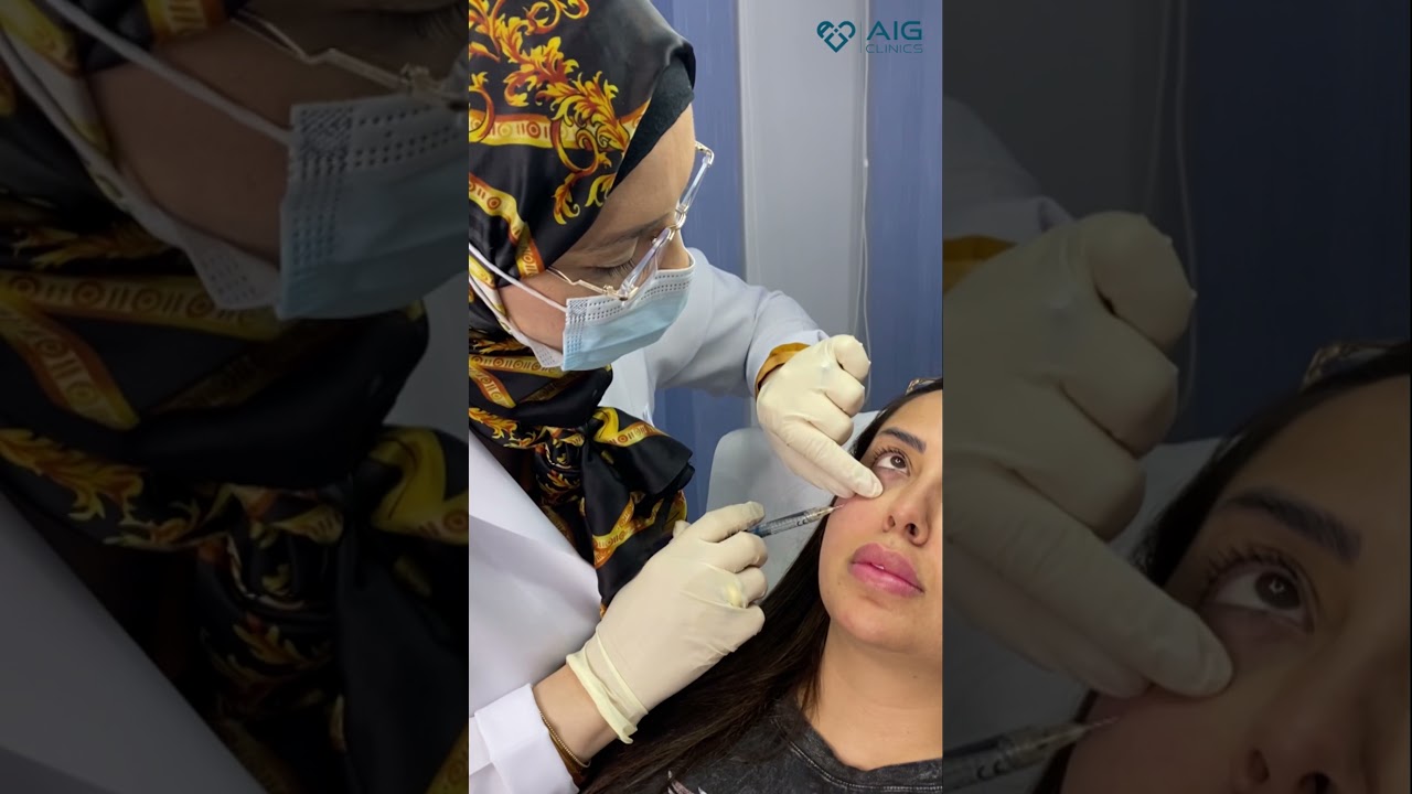 Under eyes filler - فيلر تحت العينين