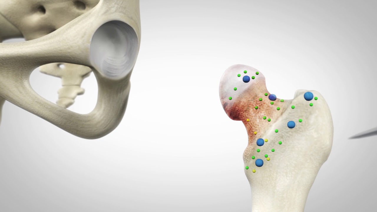 Mako robotic arm assisted surgery - Total Hip Replacement