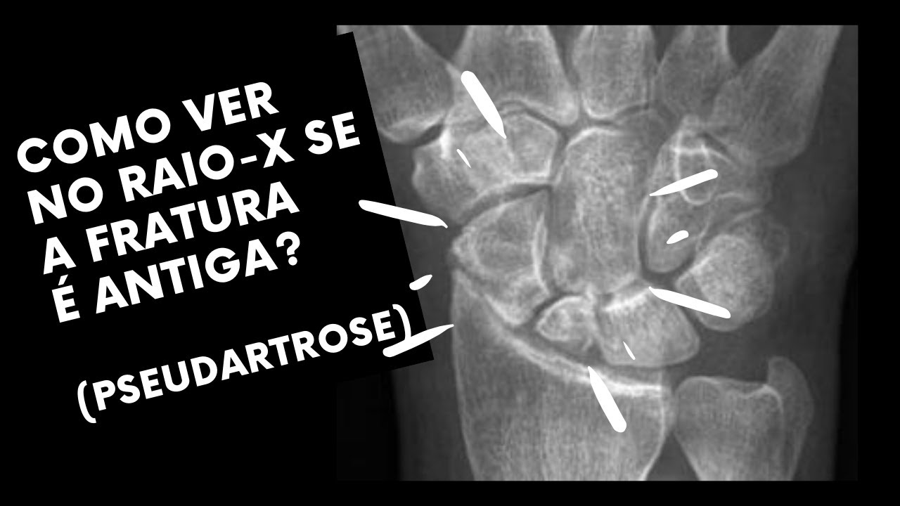 Fratura recente ou antiga? - Pseudartrose
