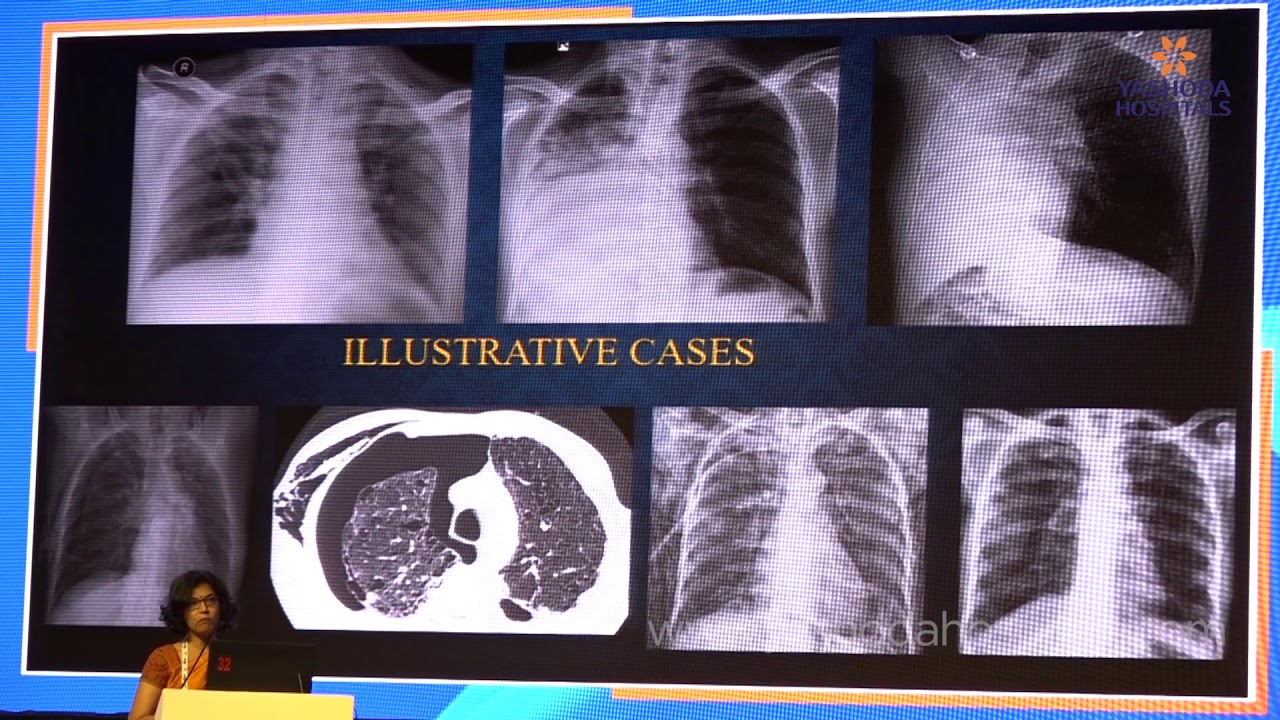 Bronchus 2020 | Intersection of Interventional Pulmonology and Palliative Medicine