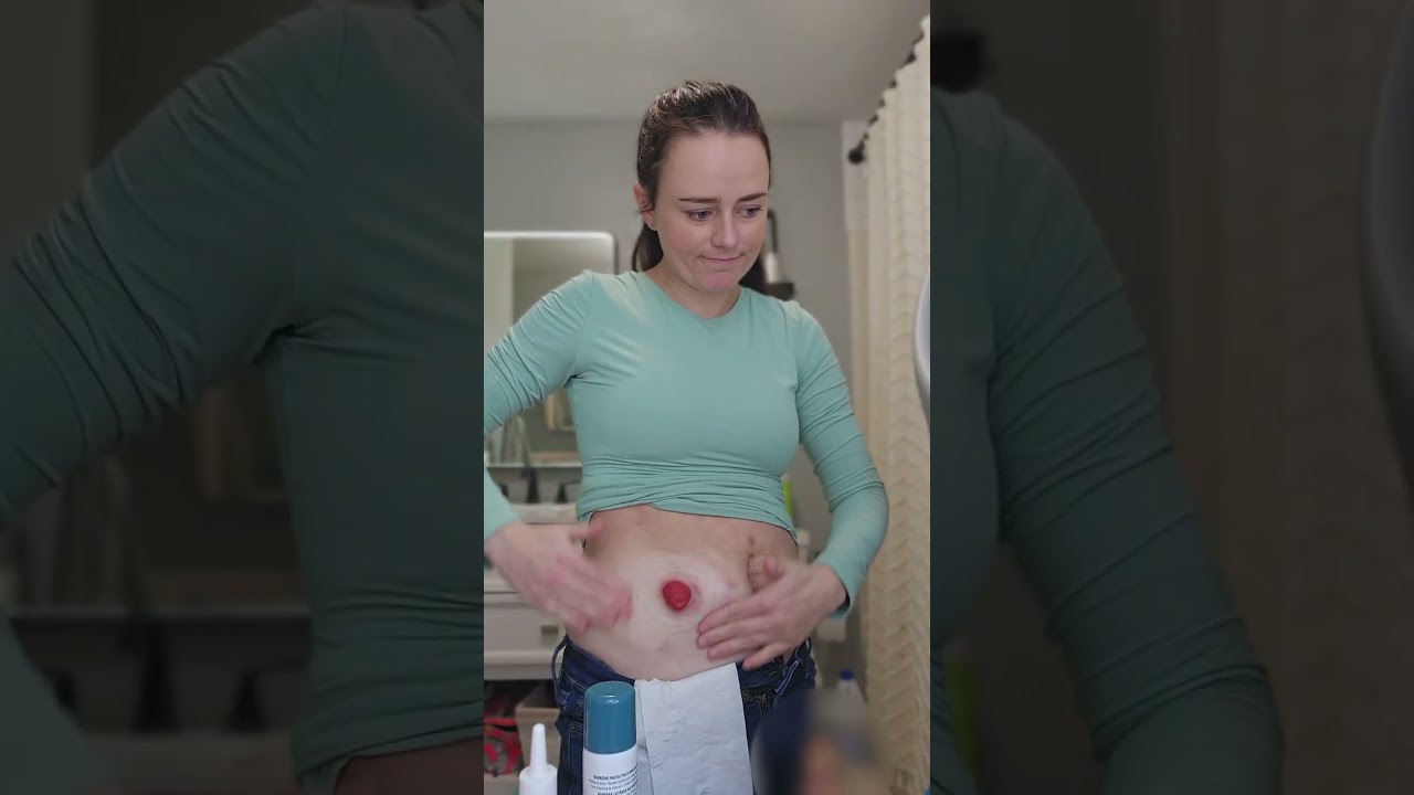 An uncut ostomy change! | Let's Talk IBD