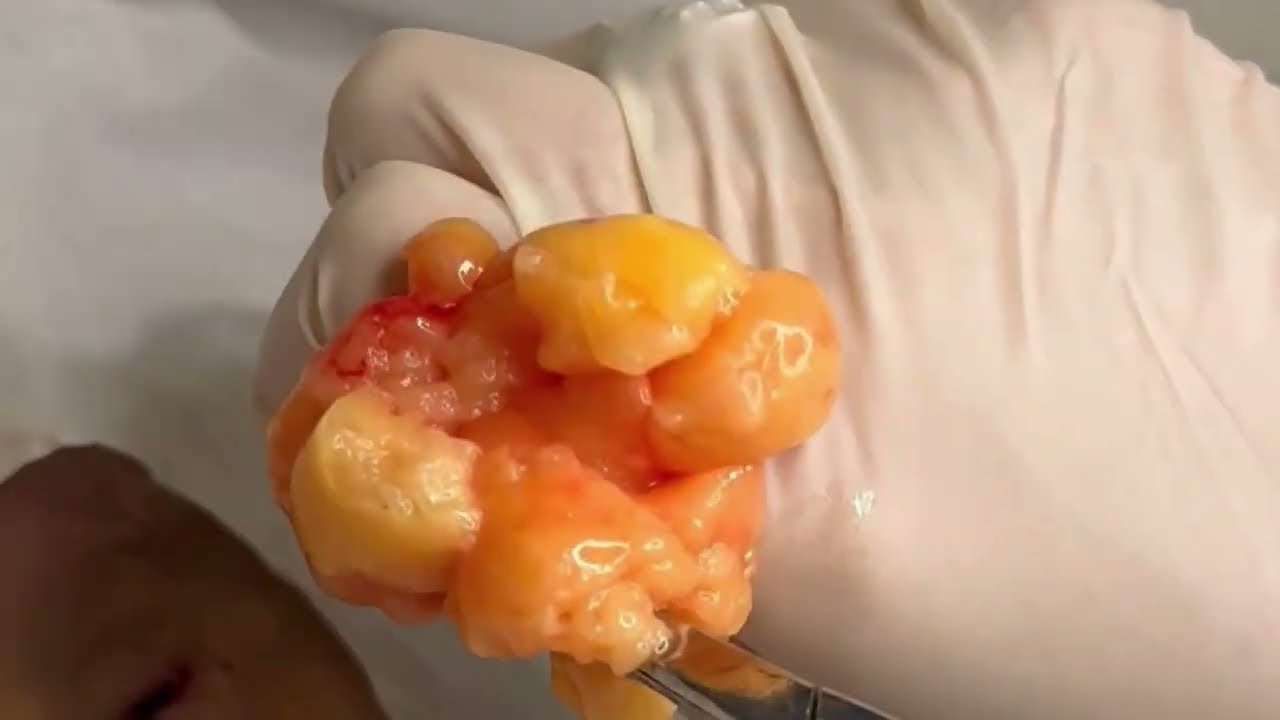 Fast and Safe Lipoma Removal Surgery with Dr. Shafa - OC Mederm /Irvineskin