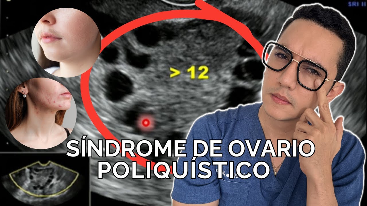 Síndrome de ovario poliquístico, todo lo que debes saber | Dr. William Guerrero