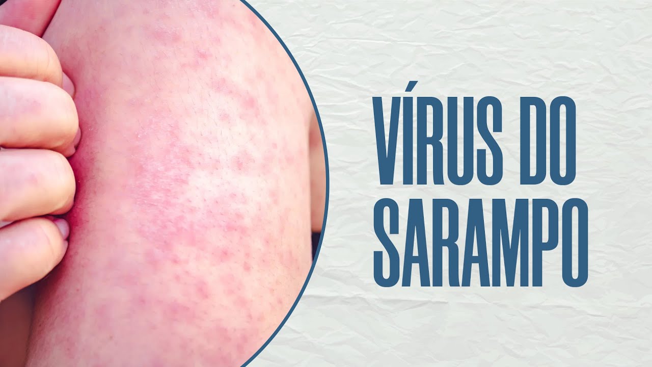 Residência Médica: Microbiologia - Vírus do Sarampo | Unilink Educacional