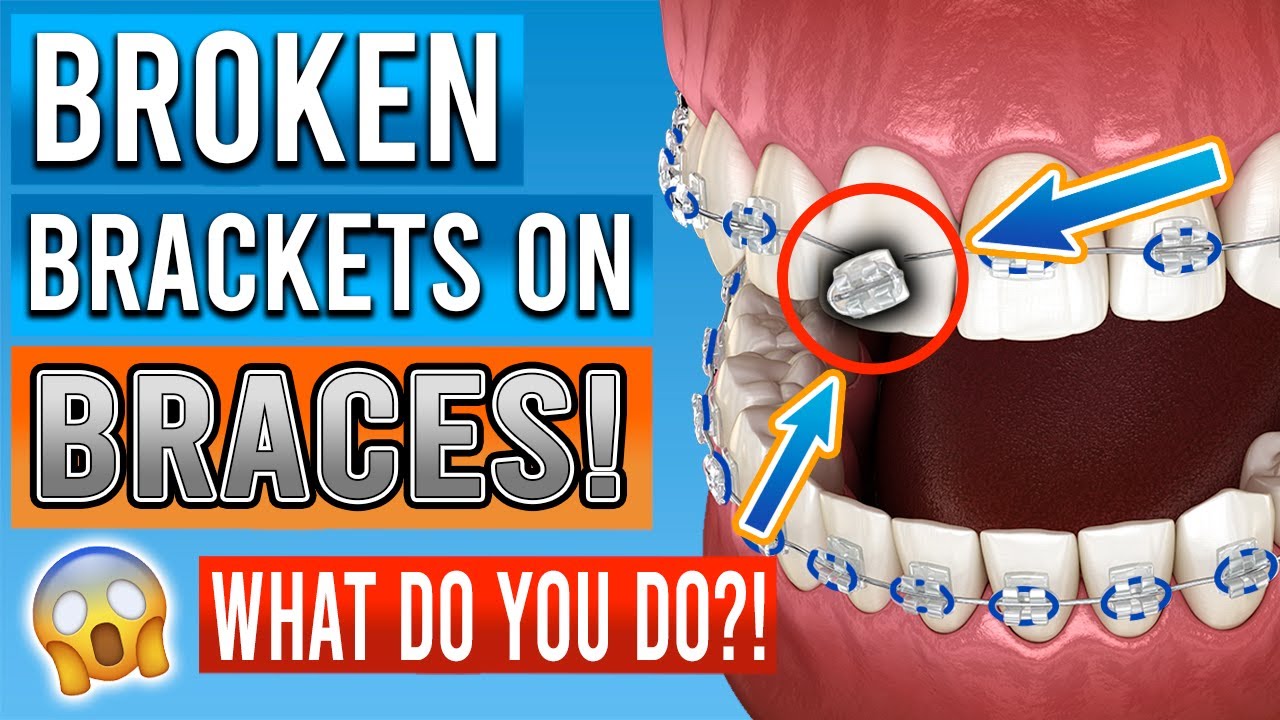 Broken Braces Brackets: What You Need To Know!