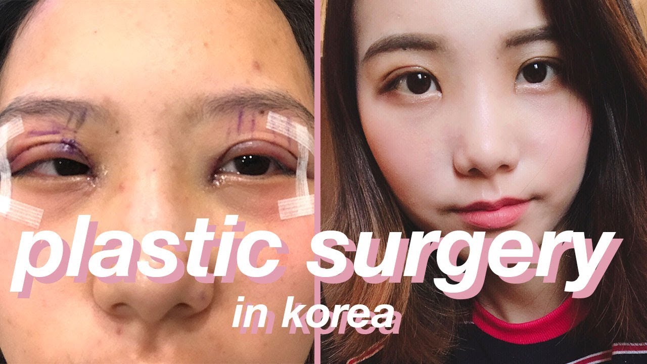 double eyelid surgery recovery vlog | gangnam seoul south korea