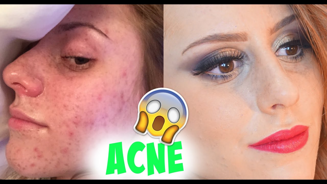 Como eu me livrei das ESPINHAS (ACNE)