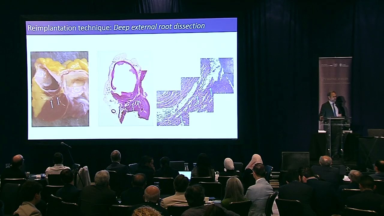 Repairing the Aortic Valve - Laurent De Kerchove