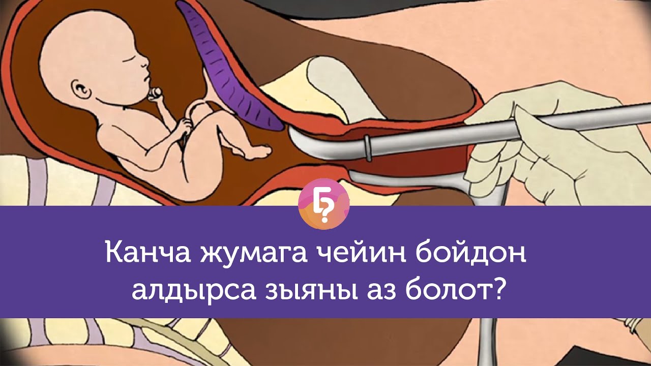 Бир жолу бойдон алдырса кийин төрөбөй калабы Аборт тууралуу