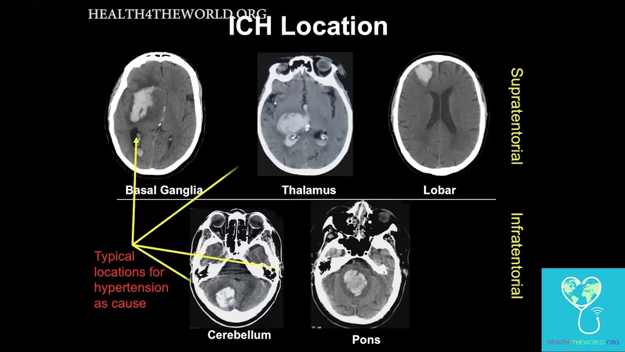 Intracerebral Hemorrhage   Part 2 | Health4TheWorld Academy