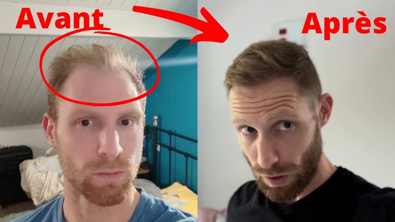 Implants 6 Mois après, incroyable 🤯