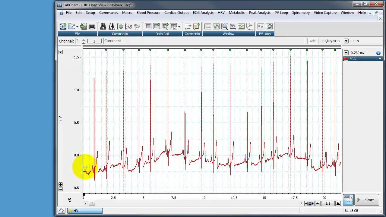 Using a Macro in LabChart to calculate RR intervals and Heart Rate Variability (HRV)