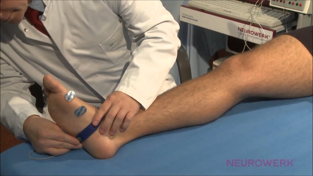 Motoric Neurography - Tibial Nerve