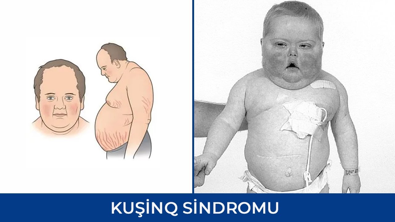 Kuşinq sindromu nədir? - Ramin Məmmədzadə ( Endokrinoloq - Dietoloq )
