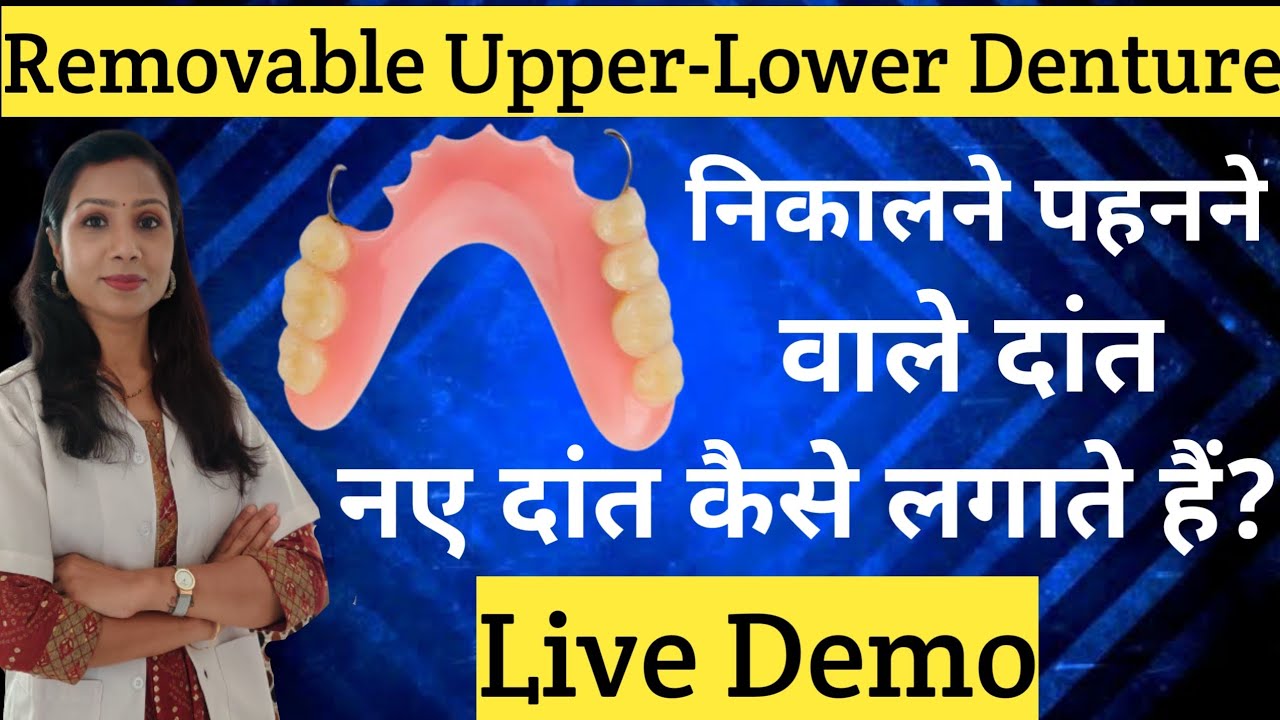 Removable Partial Denture |नए दांत कैसे लगाते हैं |Naye Dant Lagane Ka Kharcha |Battisi Ka Kharcha