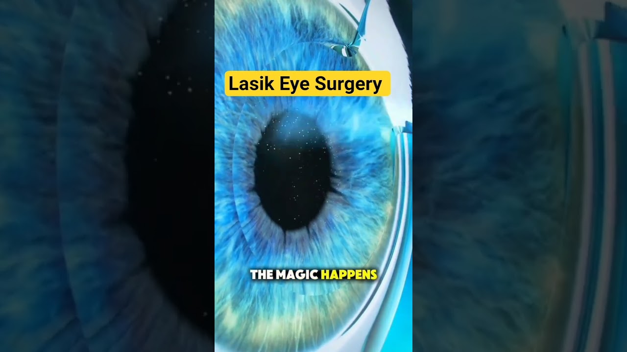 How LASIK Eye Surgery Is Performed #medical3danimation #3dmedicalanimation #lasikeyesurgery #lasik