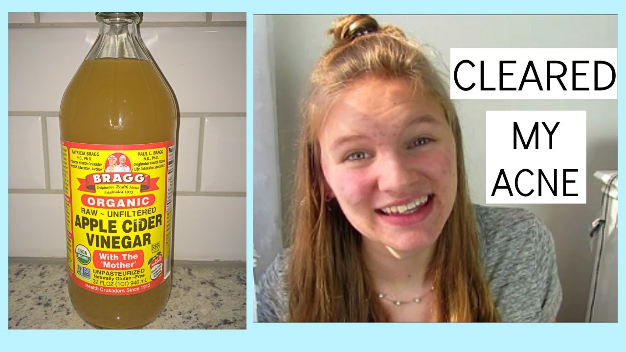 APPLE CIDER VINEGAR CLEARED MY ACNE | Grace Jennings