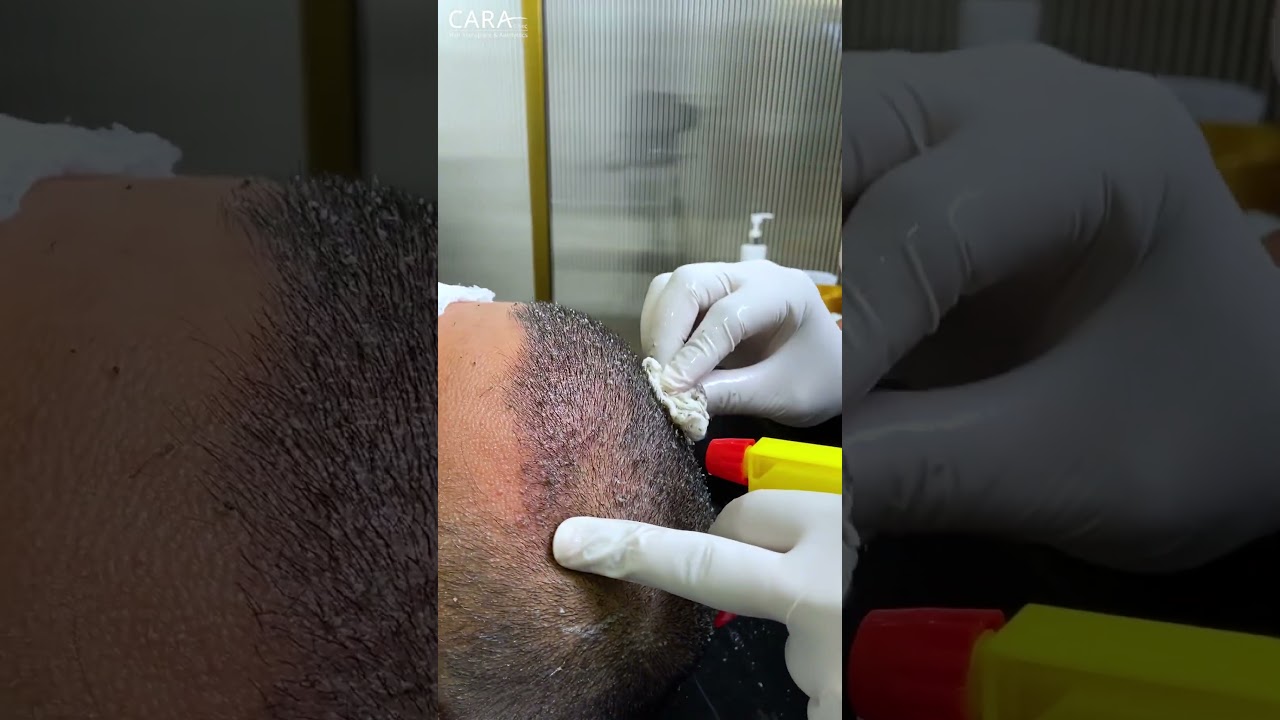 First Shampoo Headwash after Hair Transplant | Cara Clinic