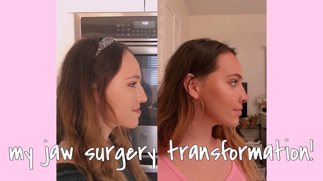 my journey with upper jaw surgery| after surgery, weekly updates & pictures