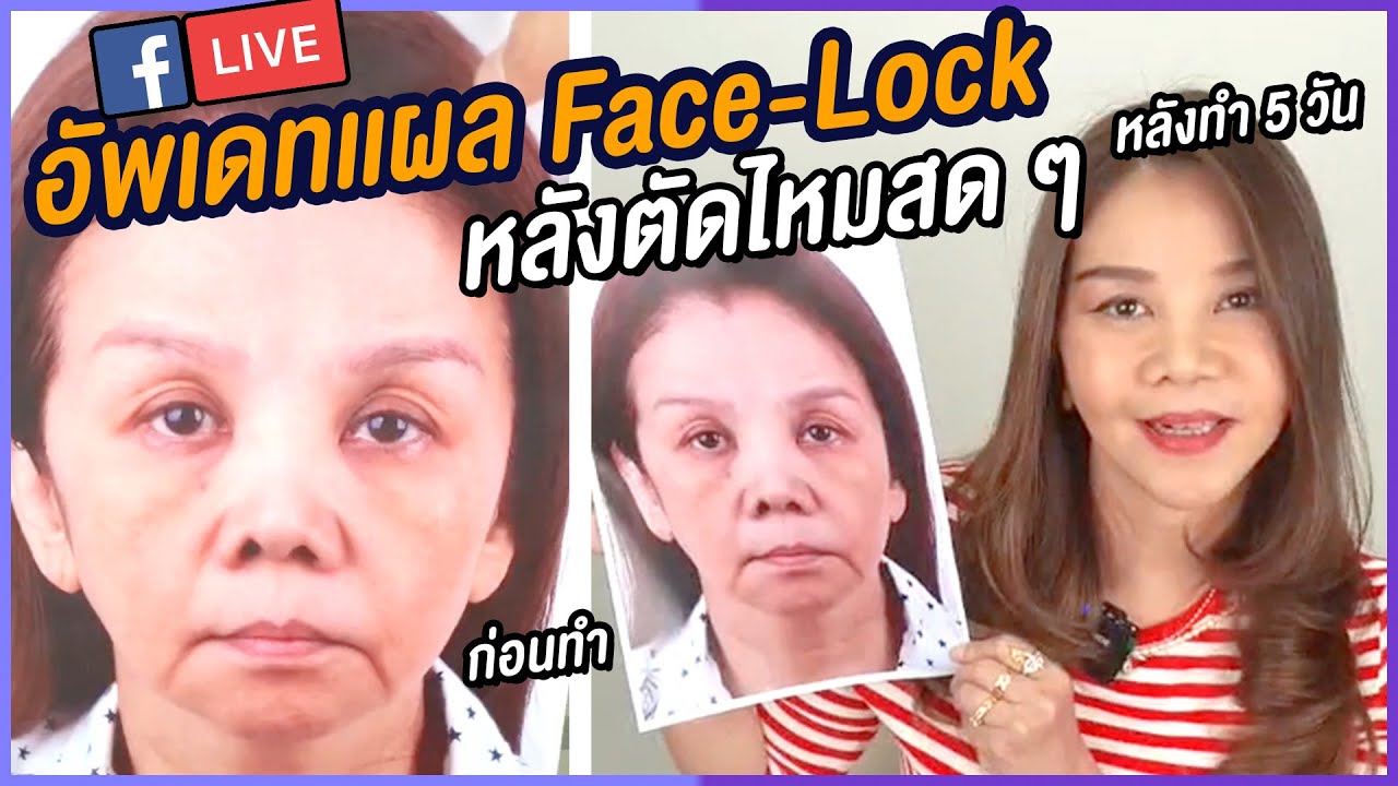 Live🔴 เพิ่งตัดไหมดึงหน้ามาสดๆ ศัลย์ครั้งเเรกในชีวิต หลังทำดึงหน้าFace-Lock 2 ช่วงครบ 5 วัน