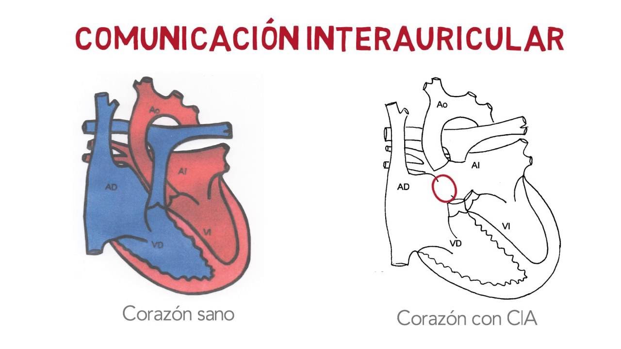 CIA - Comunicación interauricular