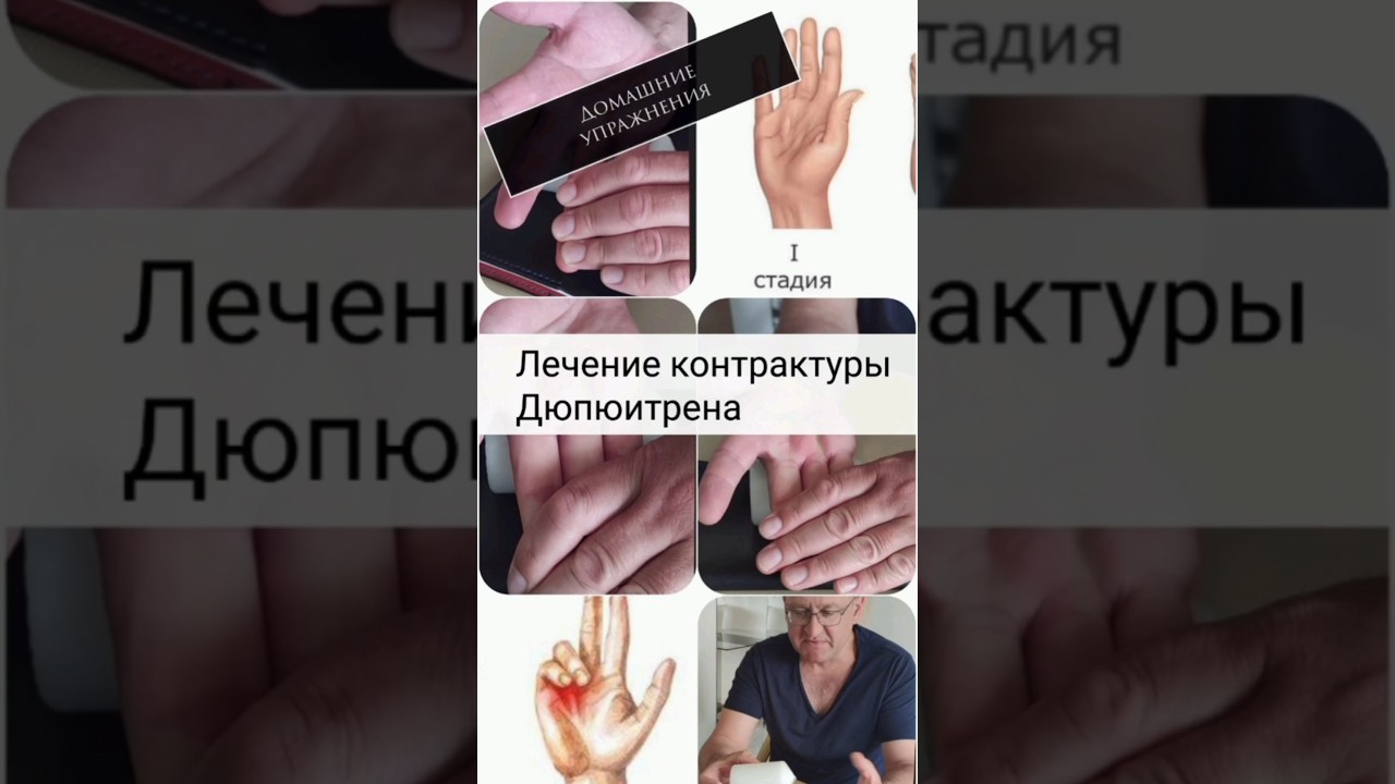 Контрактура Дюпюитрена -лечение/ Домашние упражнения/ Home Exercises for Dupuytren's Contracture