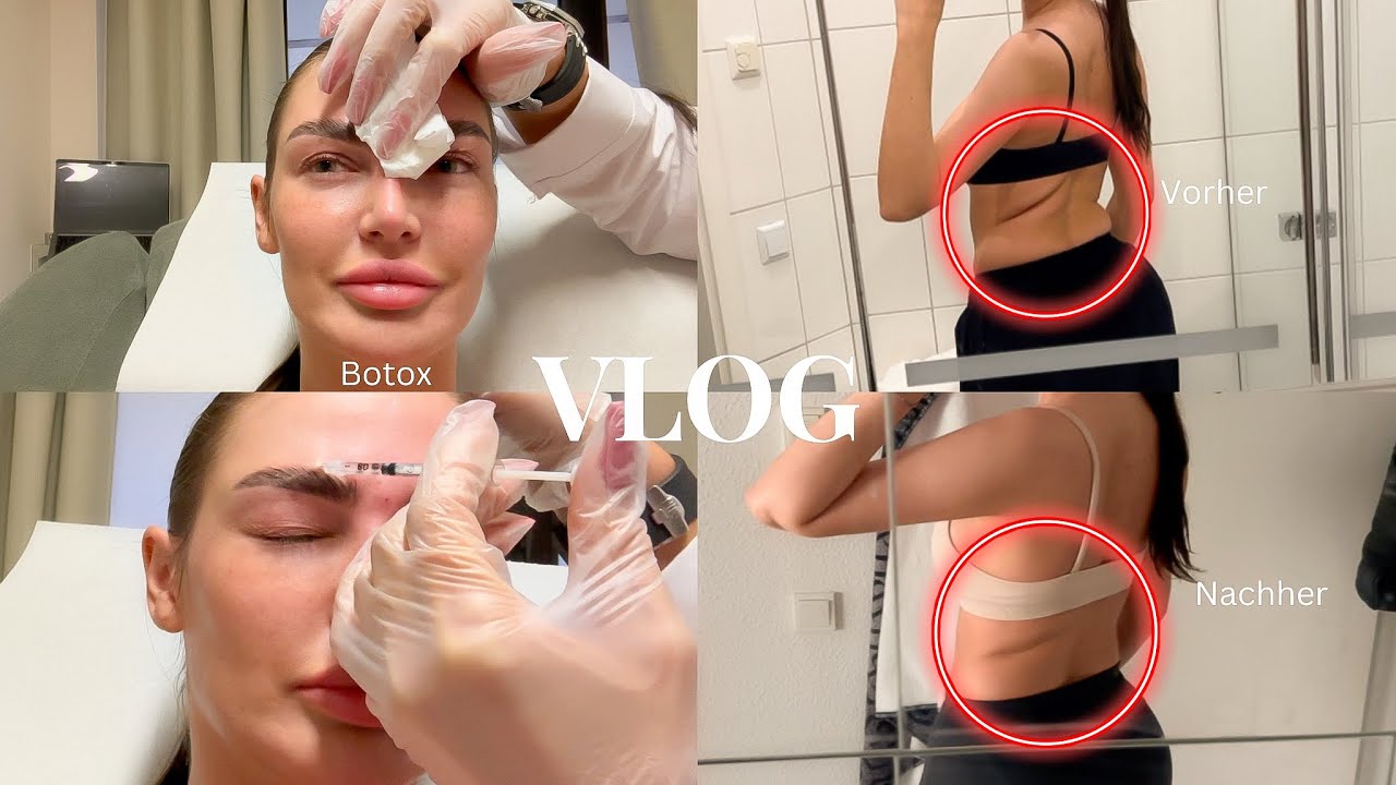 Lemon Bottle am Rücken, BBL OHNE OP, Botox etc. - VLOG