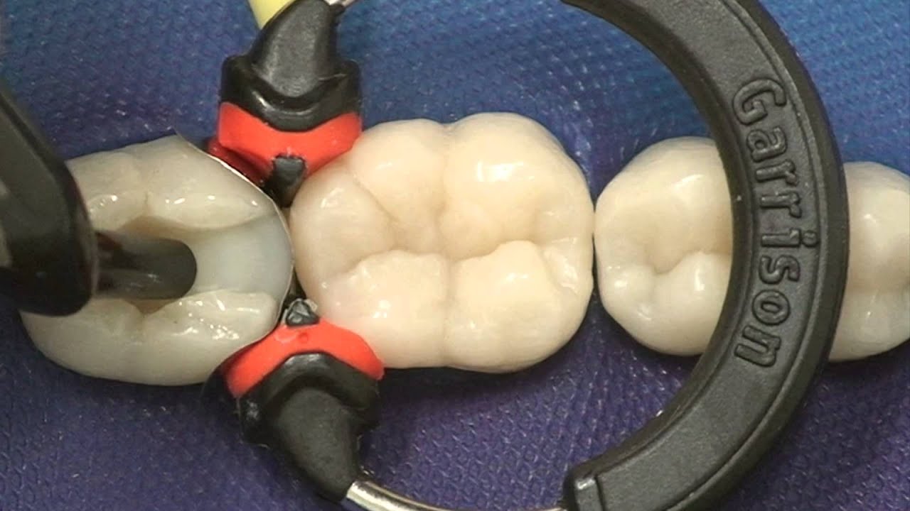 MOD Composite Restoration - Bulk-fill Technique