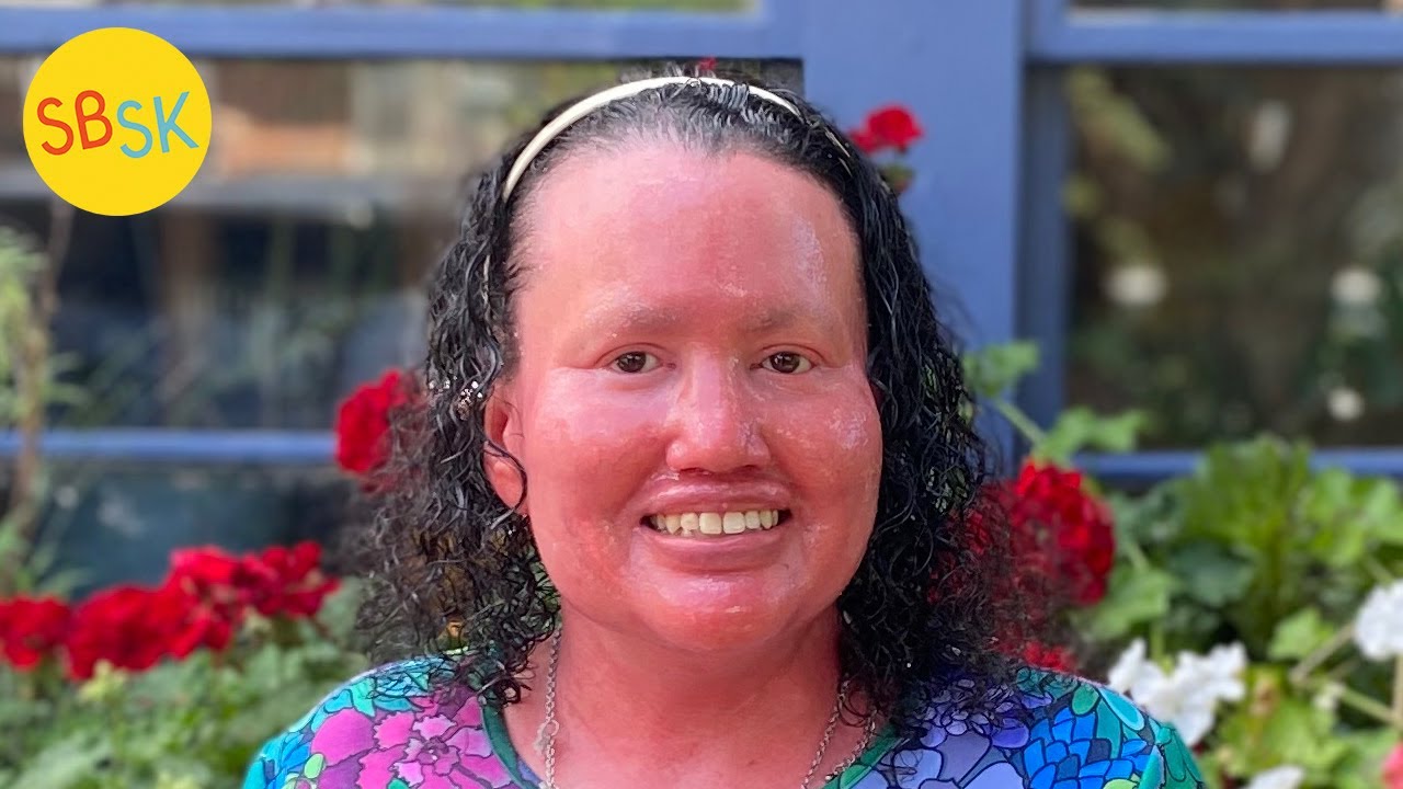 Life as an Adult with Ichthyosis (Carly Findlay's Story)