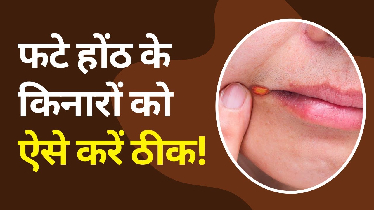 How to Treat Angular Stomatitis (Angular Cheilitis) Naturally