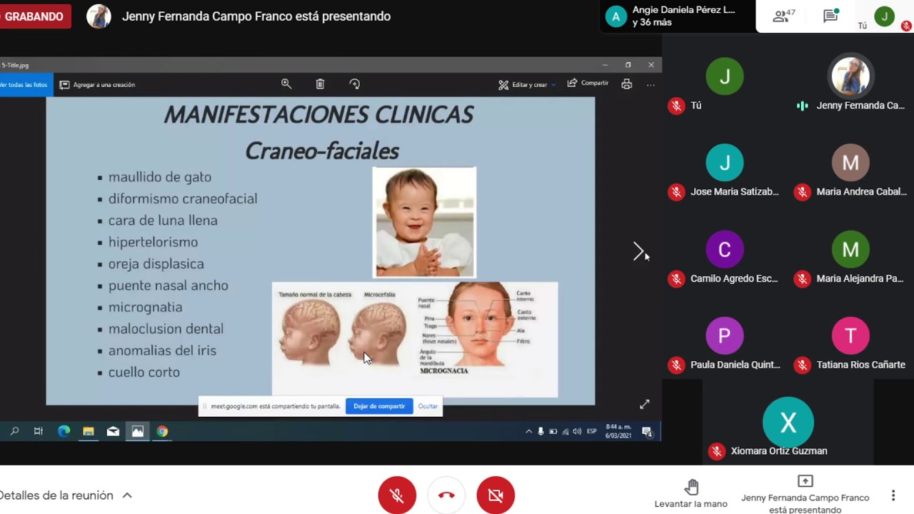 Genética - Exposición Síndrome de Cri Du Chat.