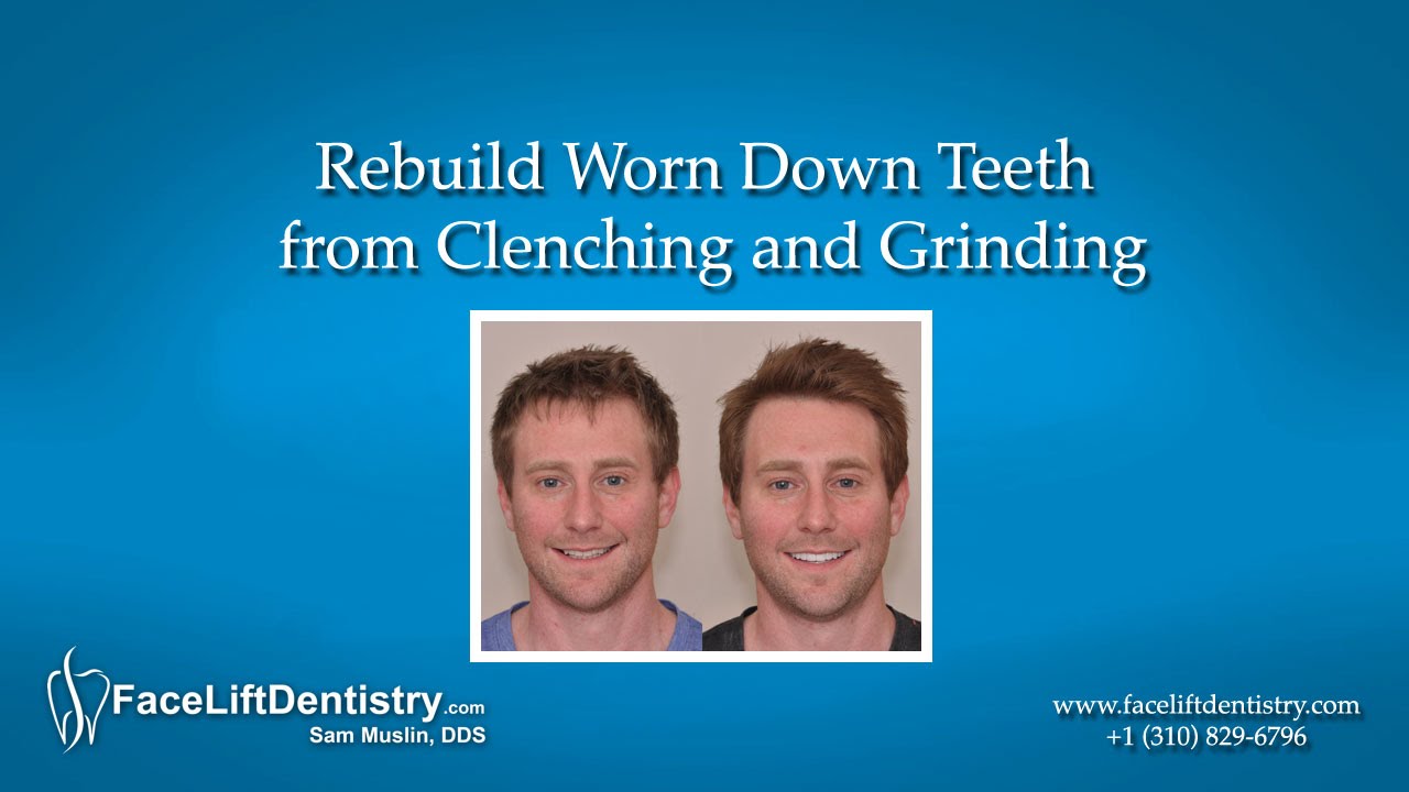 Rebuild Worn Down Teeth from Clenching and Grinding