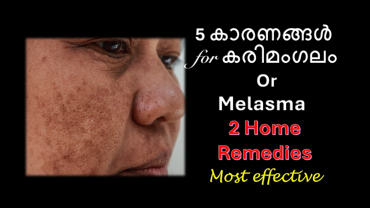 Причины мелазмы 2 Домашние средства / Средства от мелазмы /