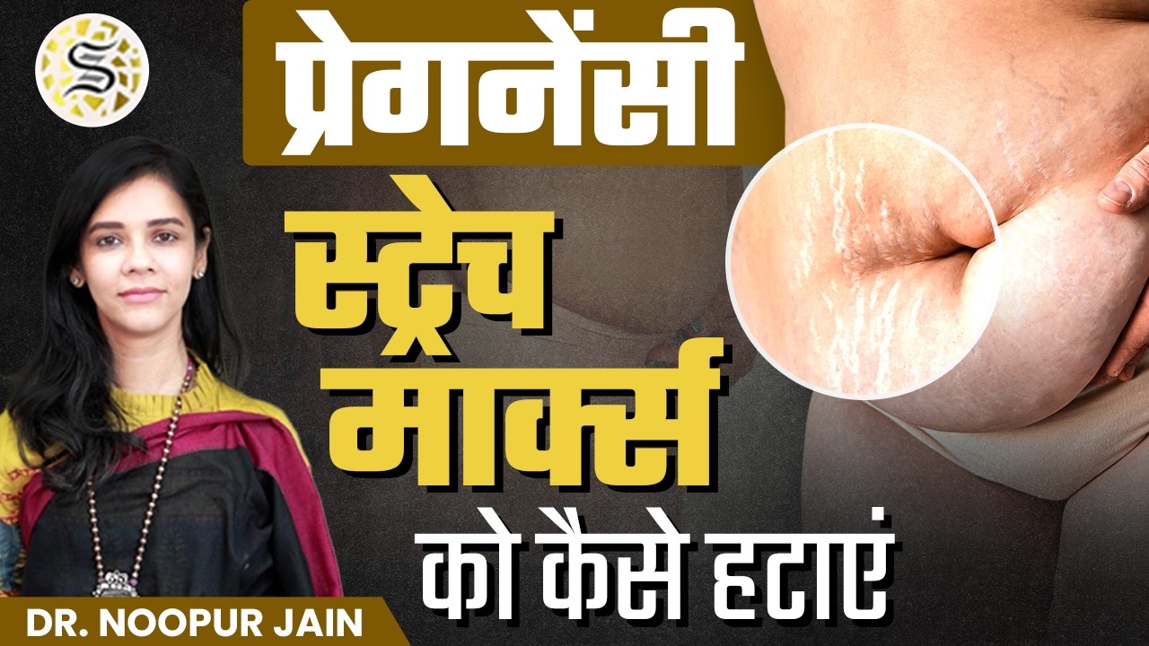 प्रेगनेंसी में स्ट्रेच मार्क्स कैसे हटाएँ | How to Reduce Stretch Marks After Delivery | Skinzest