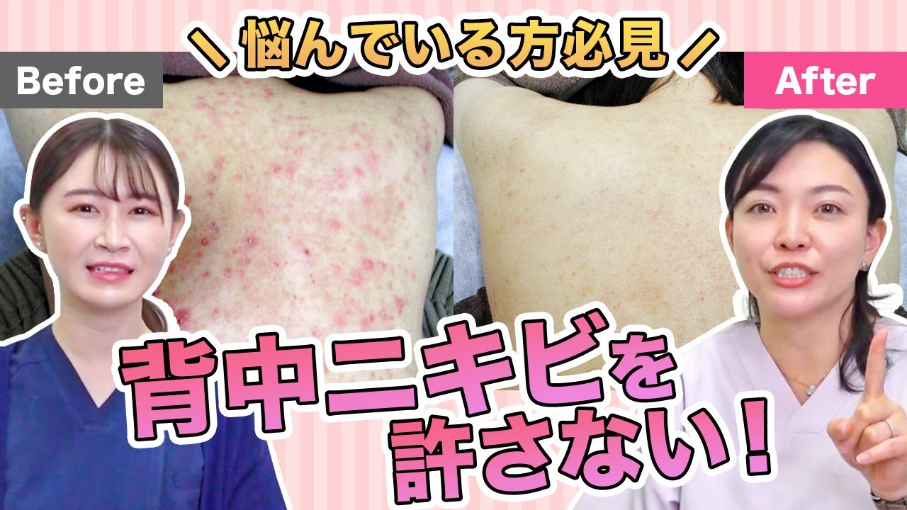【背中ニキビ】ケアしづらい背中ニキビも美容医療なら解決できる！