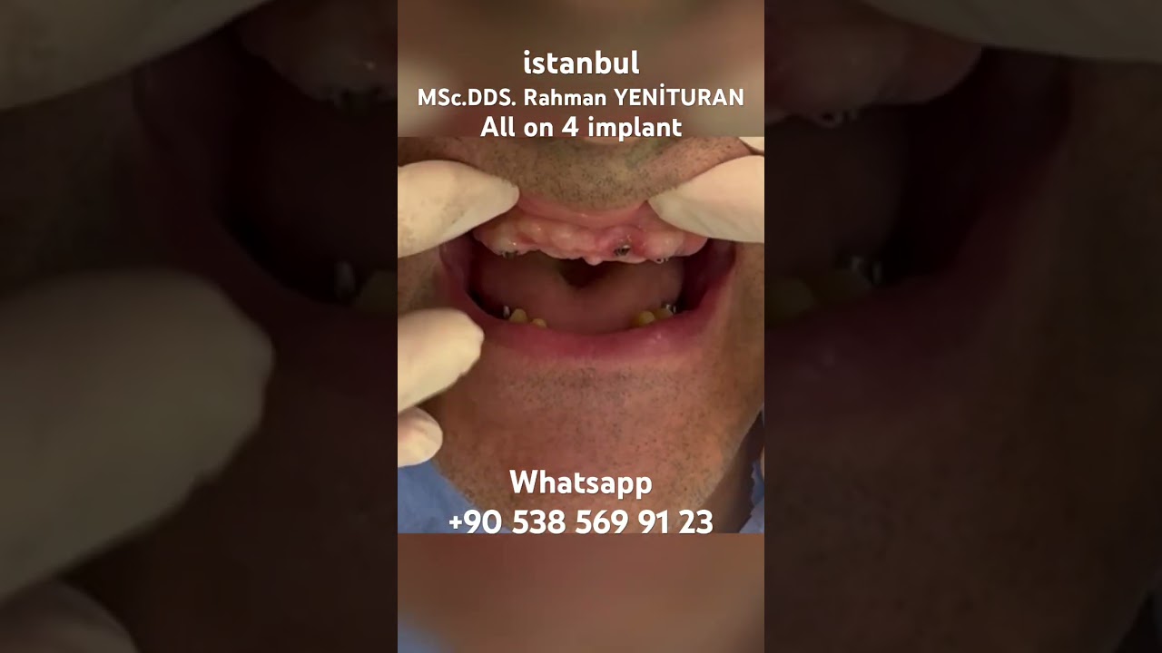 Zirkonyum - all on 4 implant #zirkonyum #implant #allonfour #allon6 #allon4dentalimplants