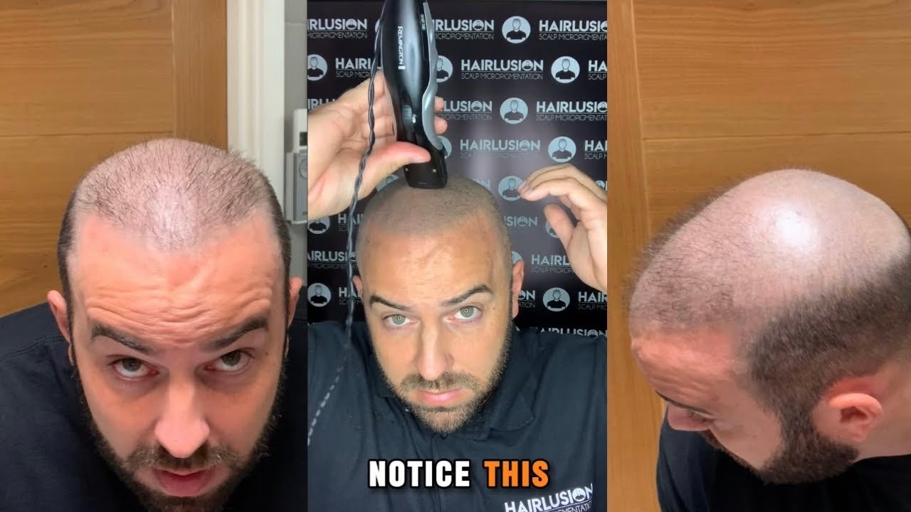 How To Shave Your Head When You Have Had SMP With The Remington Beard Trimmer