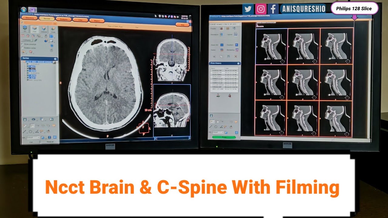 Ncct Brain & C-Spine WIth Fliming| By Anis Qureshi