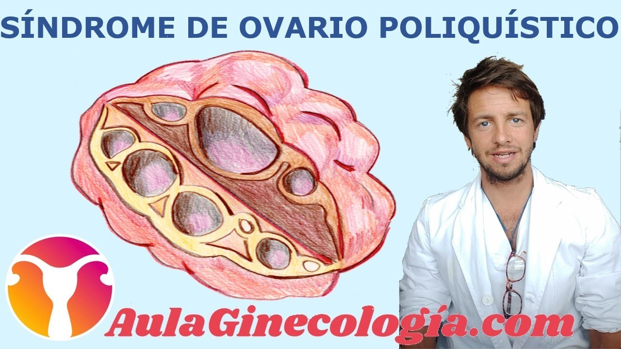 SÍNDROME de OVARIO POLIQUÍSTICO: causas, síntomas y diagnóstico.   - Ginecología y Obstetricia -