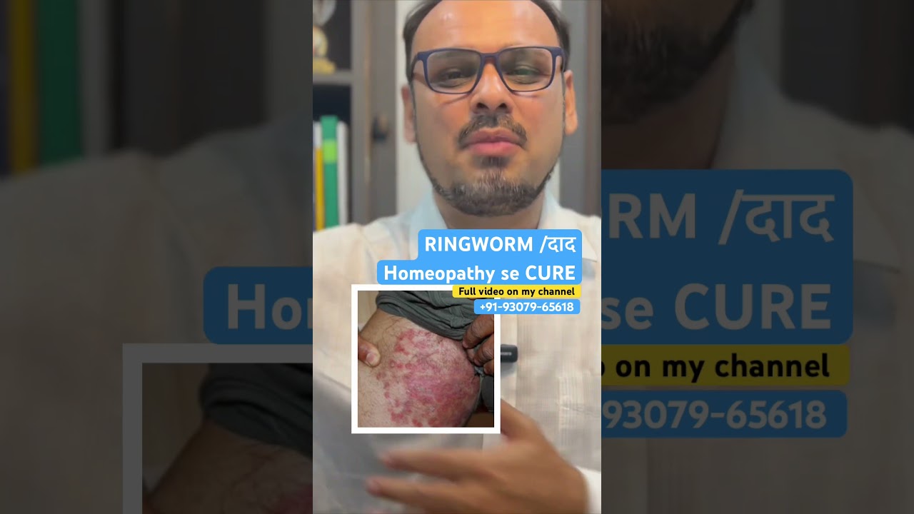 Ringworm | Today we will learn about medicines and their potency. #ringworm #doctor