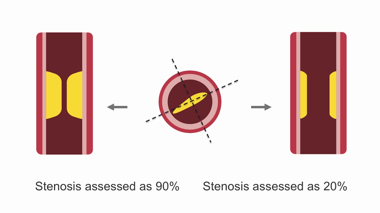 Assessing Lesion Severity in Coronary Angiography
