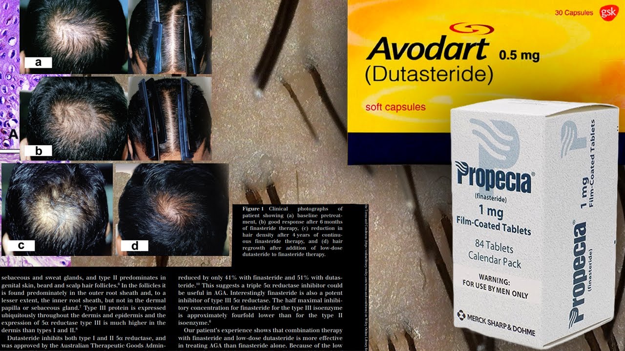 Dutasteride/Finasteride in the Hair Follicle