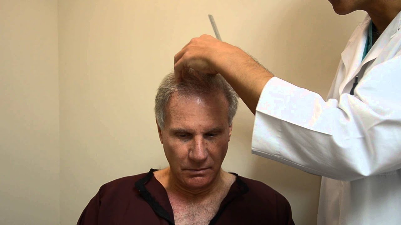 Dr. Jeffrey Epstein - Hair Transplant