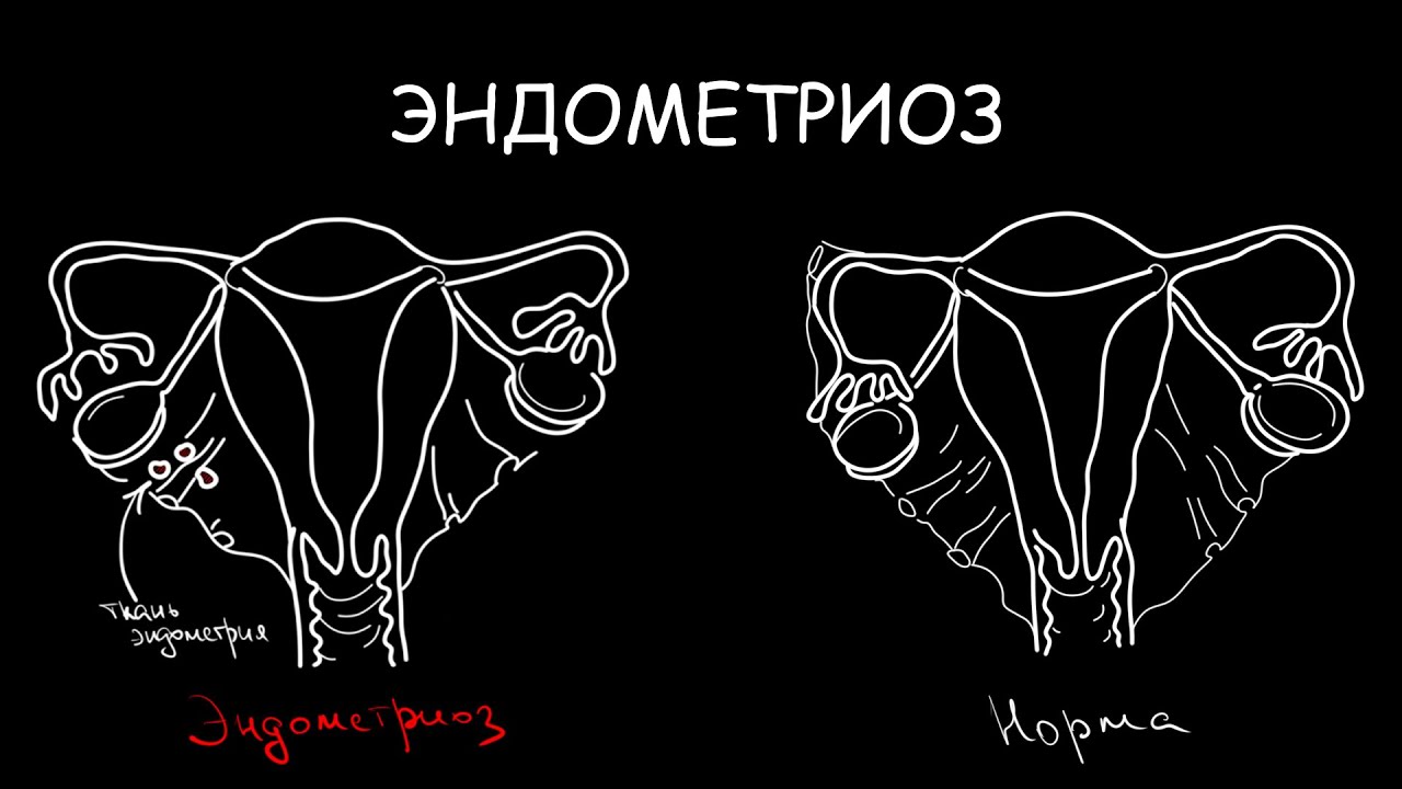 Эндометриоз. Патофизиология, клиника, диагностика и лечение
