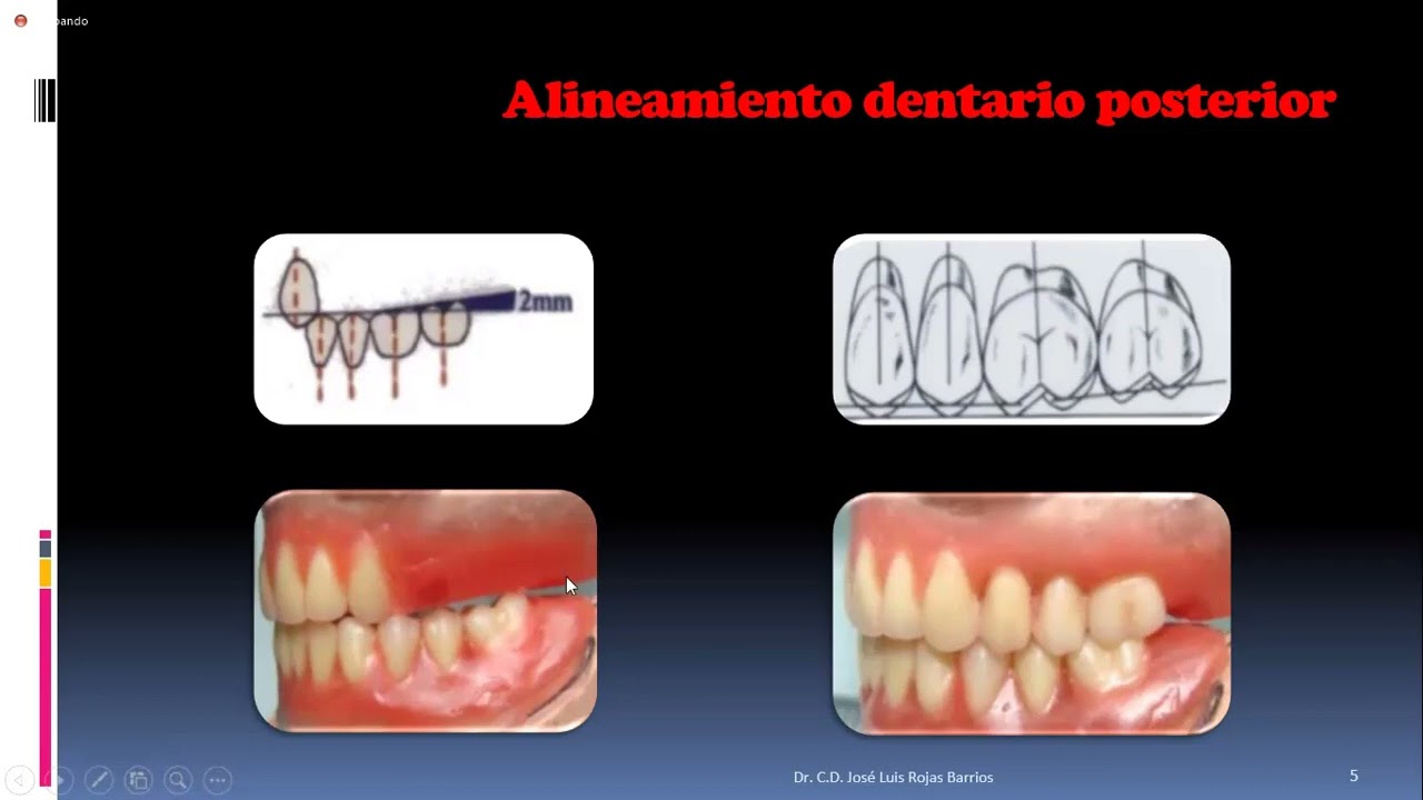 PRÓTESIS TOTAL ENFILADO o ARTICULADO DE DIENTES SUPERIORES