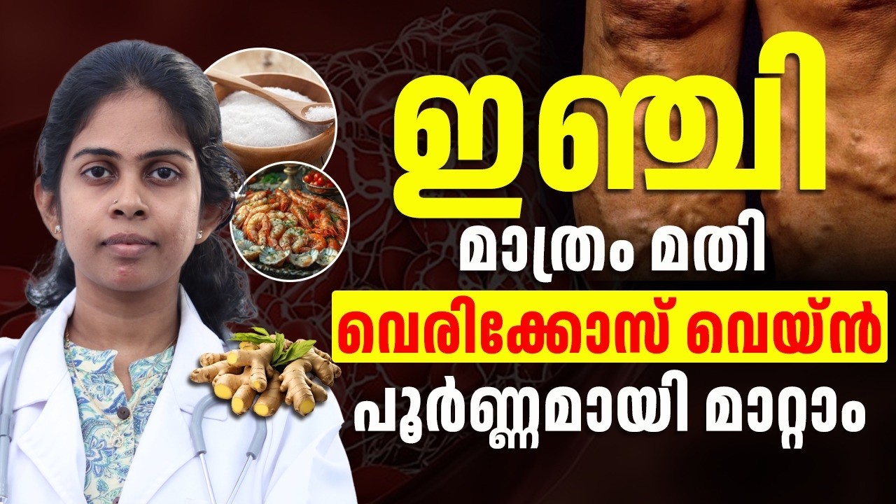 ഒരു ചെറിയ ഇഞ്ചി മാത്രം മതി കാലിലെ വെരിക്കോസ്  വെയിൻ പൂർണ്ണമായി ചുരുക്കി കളയാൻ