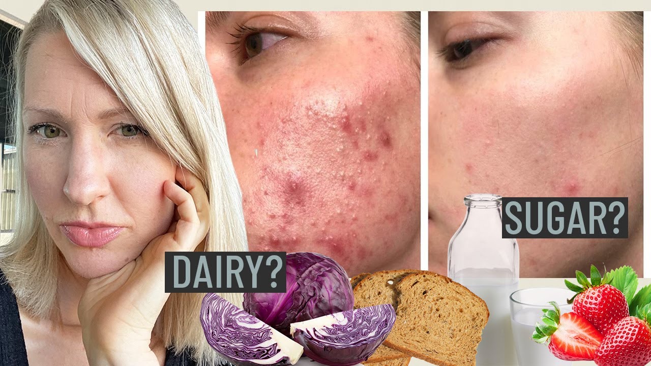Dietitian FACT CHECKS the Hormonal Acne Diet: Is Food Causing Your Acne?!