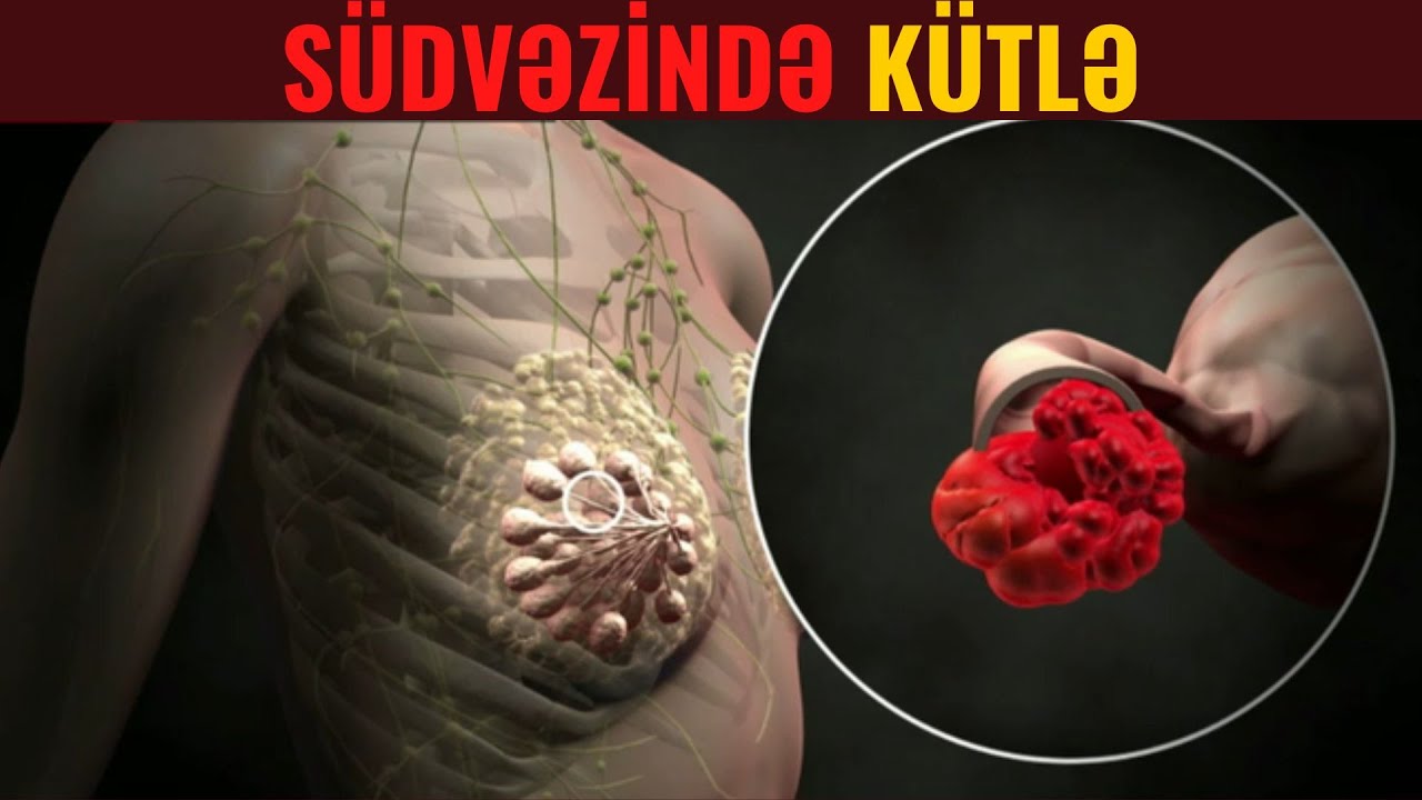 DİQQƏT! Südvəzinizdə Kütlə varsa, Sizi bu Proseslər Gözləyir...