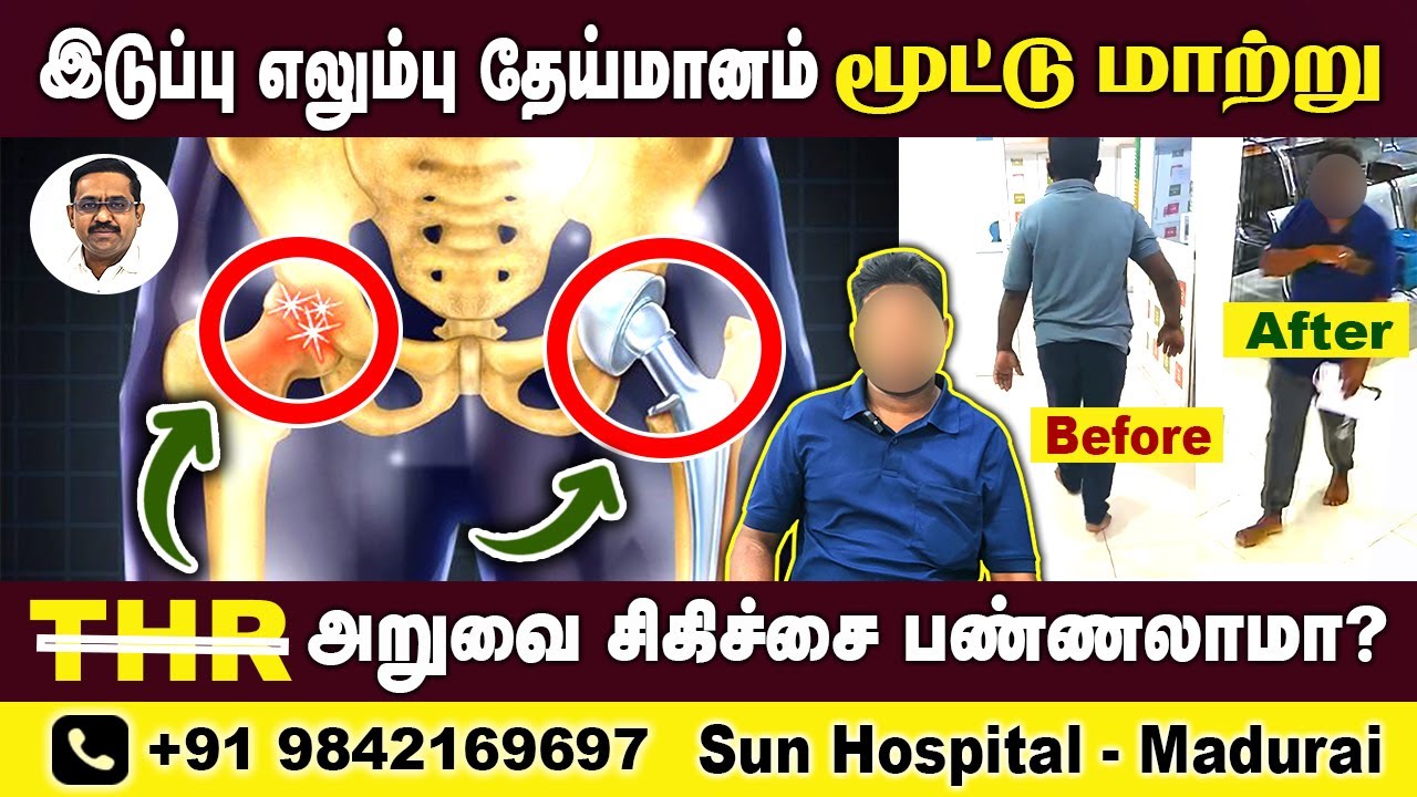 How To Avoid THR TOTAL HIP REPLACEMENT SURGERY இடுப்பு எலும்பு தேய்மானம் | AVN AVASCULAR SunHospital