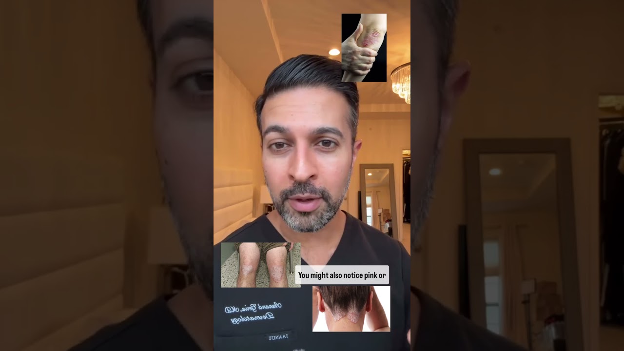 How to Spot Psoriasis